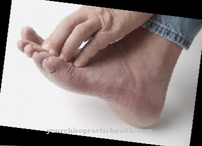 Athlete's foot treatment