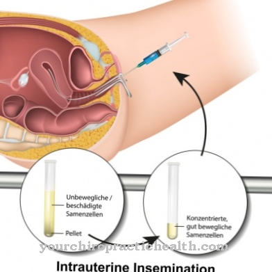 Intrauterine insemination