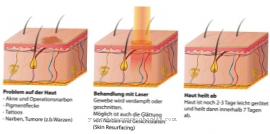 Laser treatment (laser therapy)