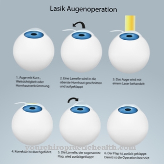 Laser coagulation