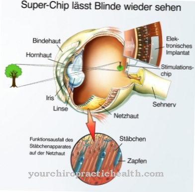Implante de retina