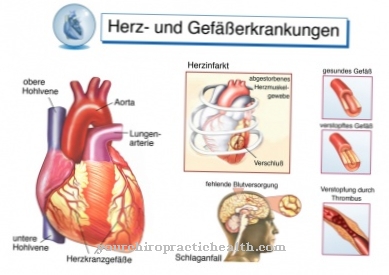 Causes et traitement de l'infarctus du myocarde et de l'angine de poitrine