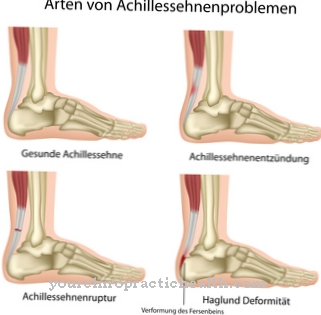 Achilles tendonitis
