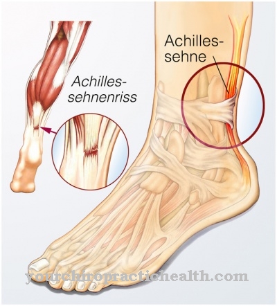 Achilles tendon tear
