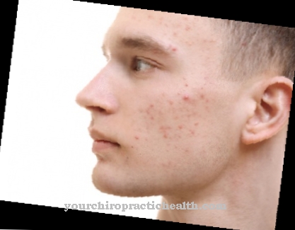 L'acné vulgaire