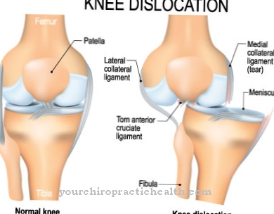 Congenital knee dislocation