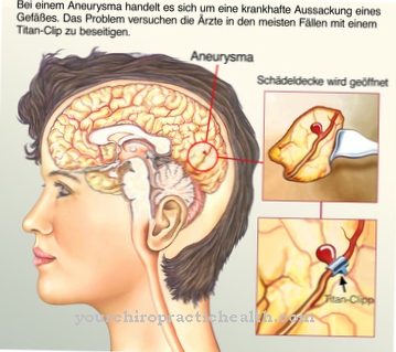 Аневризма на аортата