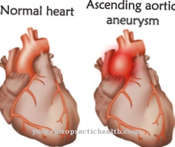 Aortan stenoosi