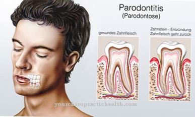Apical periodontal disease