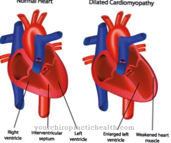 عدم انتظام ضربات القلب البطين الأيمن عضلة القلب