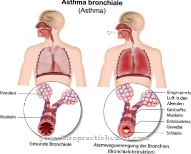 asma bronkial