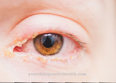 Očná chrípka (epidemická keratokonjunktivitída)