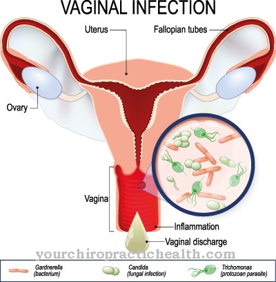 Bakteerinen vaginosis