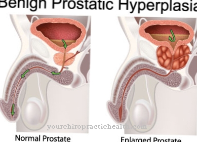 Hyperplasie bénigne de la prostate