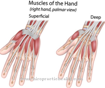 Kecederaan tendon fleksor di tangan