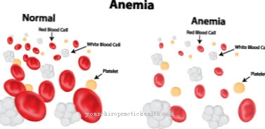 Anemia due to a lack of folic acid