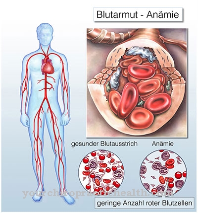 Anémia v dôsledku nedostatku vitamínu B12