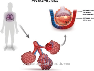 Bronchopneumonia