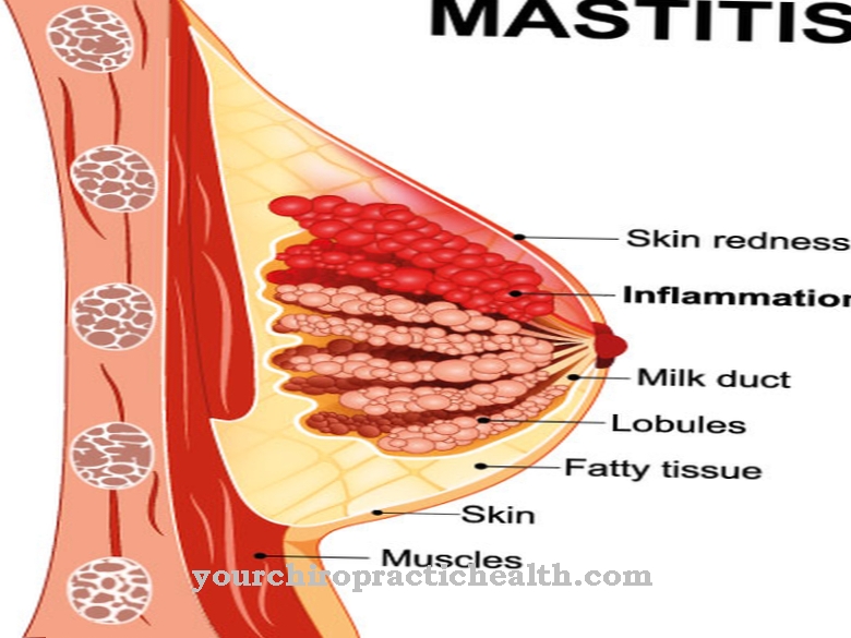 mastitisa