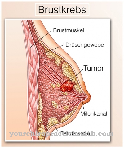 Rakovina prsníka
