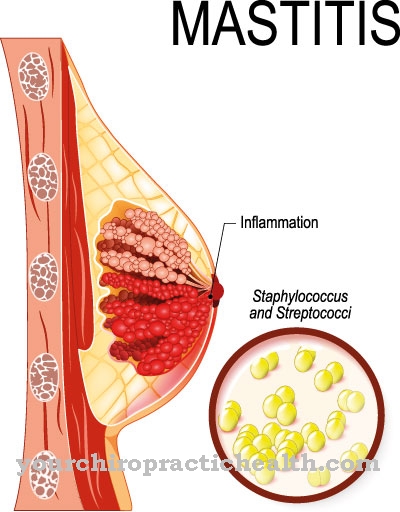 Inflammation du mamelon