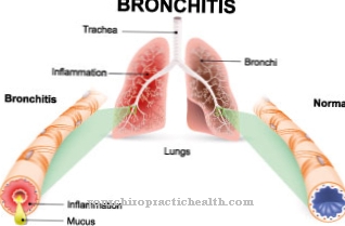 Chronic obstructive bronchitis