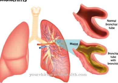 Malattie - Bronchite cronica