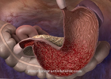Chronic inflammation of the stomach lining (gastritis)