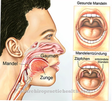 Krooninen tonsilliitti