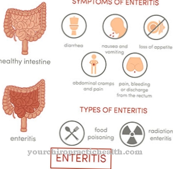 Inflamación del intestino (enteritis)