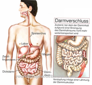Intestinal obstruction (ileus)