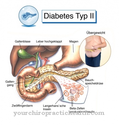 Захарен диабет тип 2