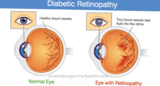 Diabeetiline retinopaatia