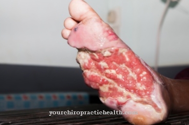 Diabēta pēdu sindroms