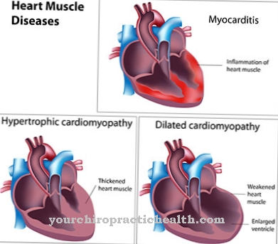 Dilatirana kardiomiopatija