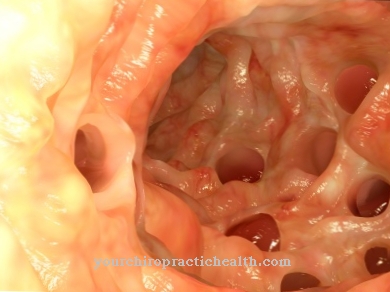 Diverticulum trong ruột (diverticulosis)