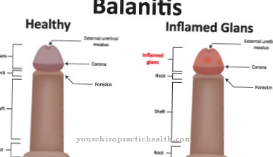 Inflammation of the glans (foreskin inflammation)