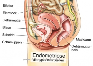 Endometrioos