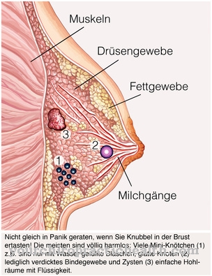 Necrosis del tejido adiposo en el pecho.