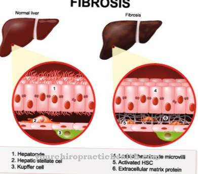 Ligos - Fibrozė (sklerozė)
