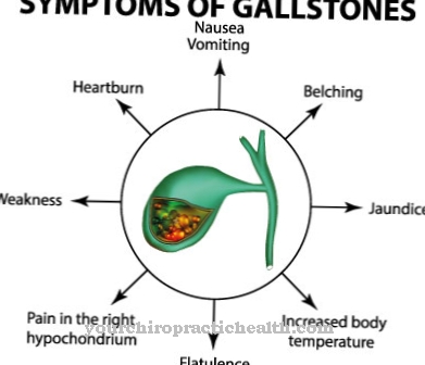 Gallstone ileus