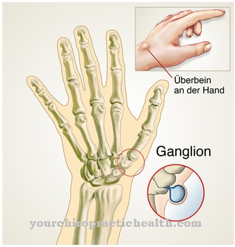 Ganglionas (viršutinė kojos dalis)
