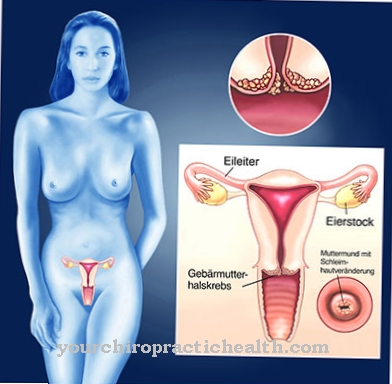 rakovina krčka maternice