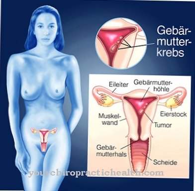 Uterine cancer (endometrial cancer)