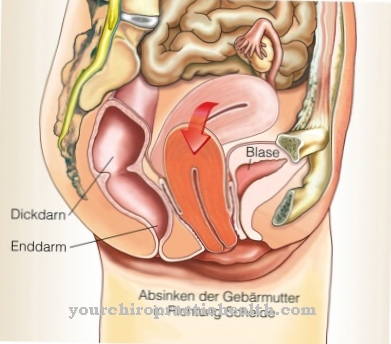 Lowering of the uterus (lowering of the vagina)