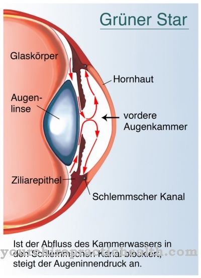 Glaucoma (green star)
