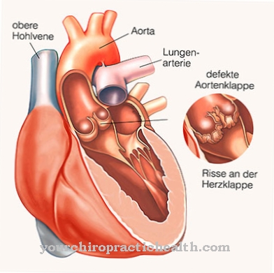 Choroby srdcovej chlopne