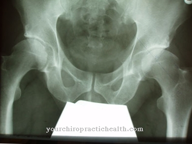 Hip dysplasia (hip dislocation)