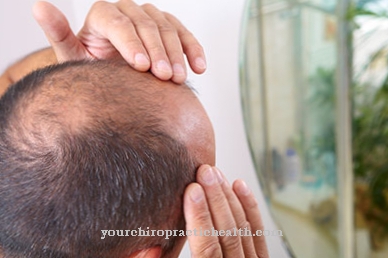 Kehilangan rambut keturunan hormon (alopecia androgenetica)