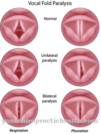 Larynx paralysis